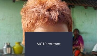 CCMB scientists identify rare gene behind Indian girl’s red hair