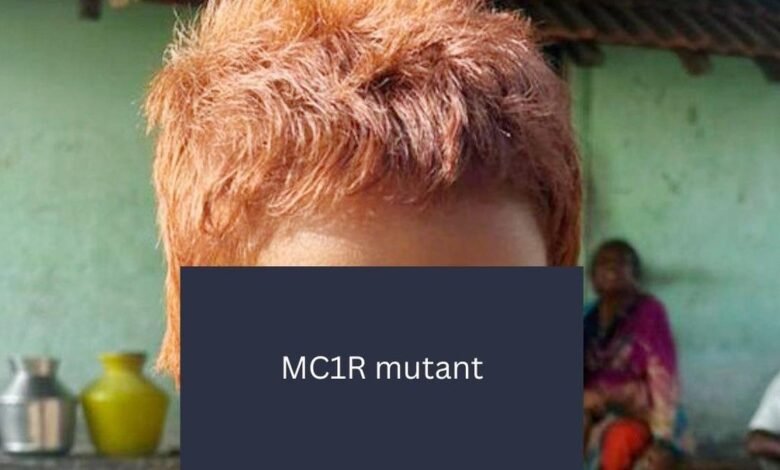 CCMB scientists identify rare gene behind Indian girl’s red hair